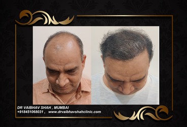 hair transplant